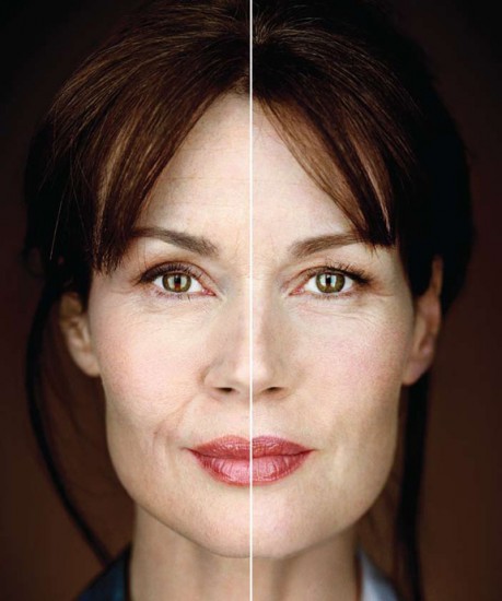 when performed by a trained professional collagen treatments can give ...