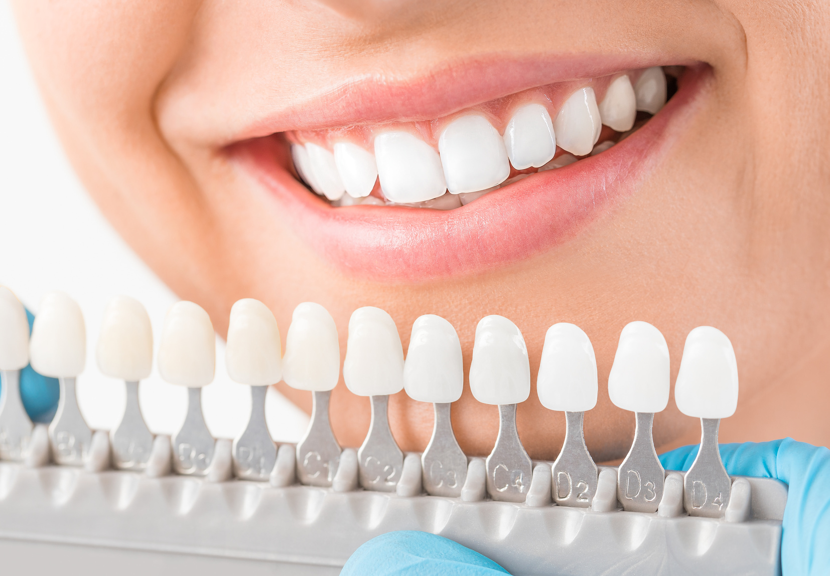 Cosmetic Teeth 5 Reasons to Get Veneers Estilo Tendances