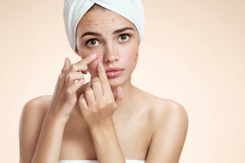 homeopathic remedies for acne