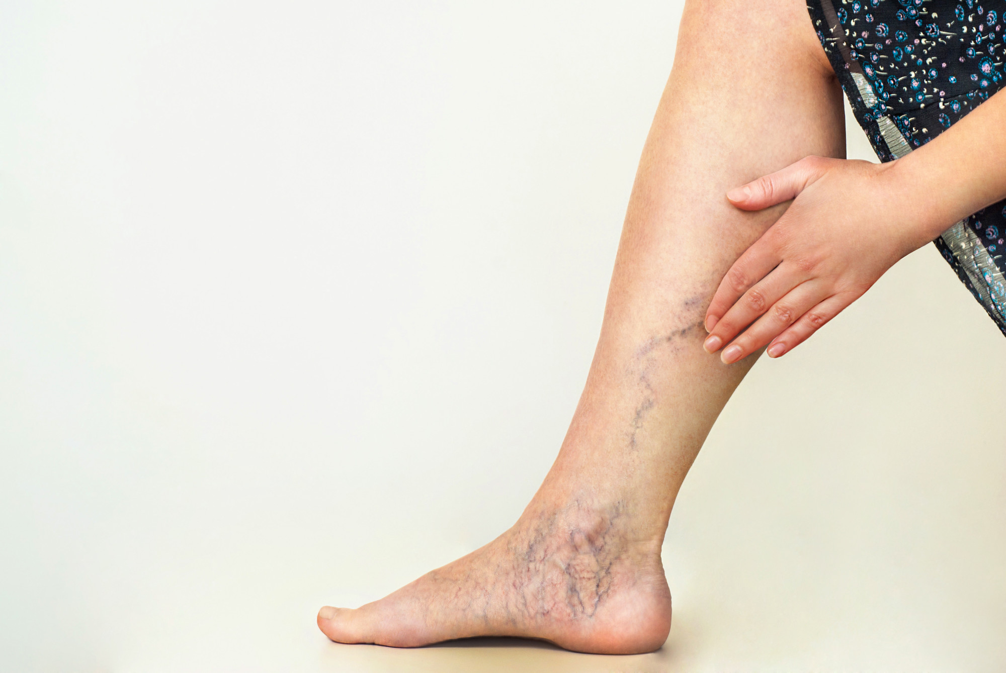 Doctor varicose, Varicose Vein Treatment: Which Approach Is Best for You? | University Health News